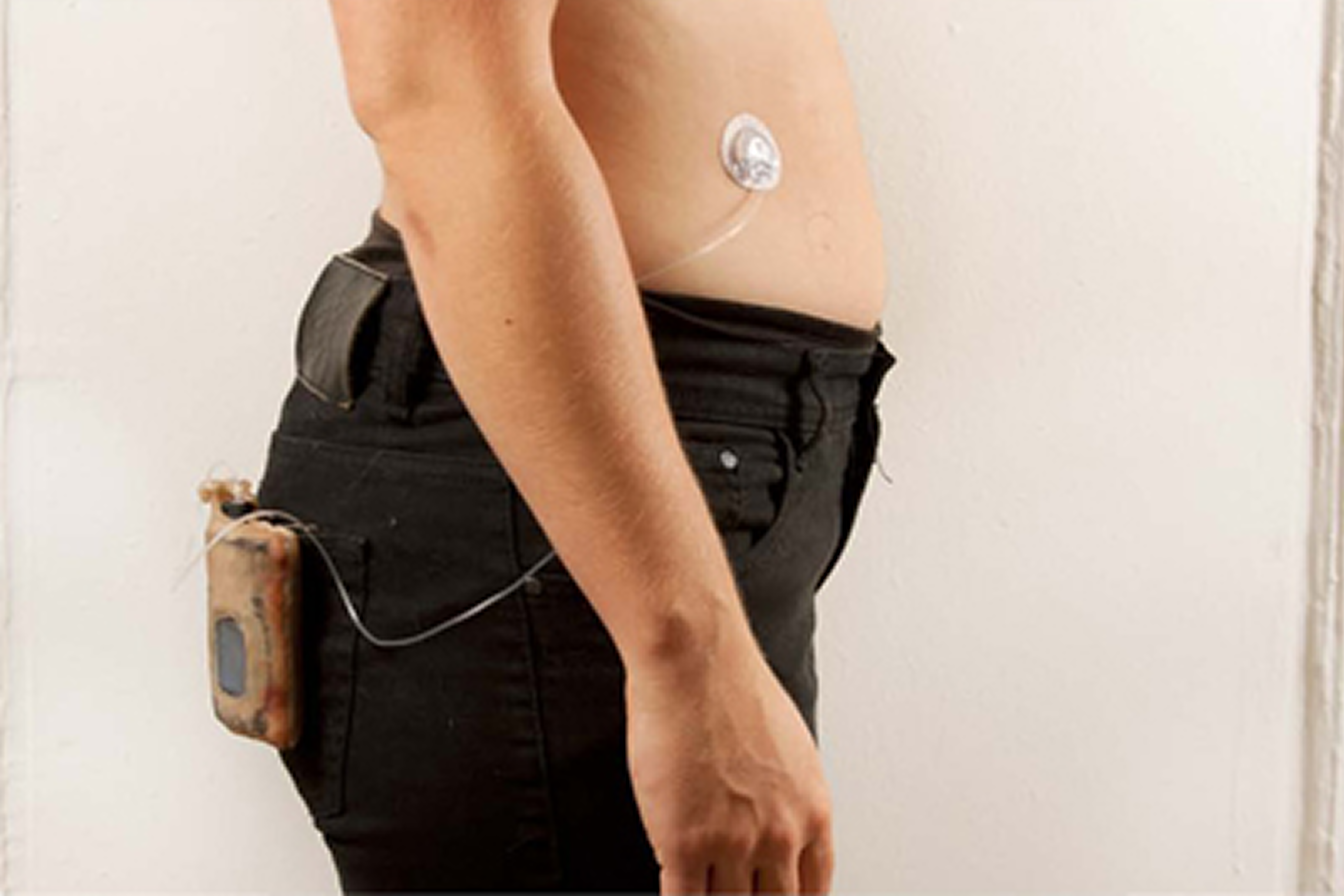 Insulin pump worn at waist