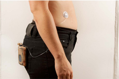 Insulin pump worn at waist