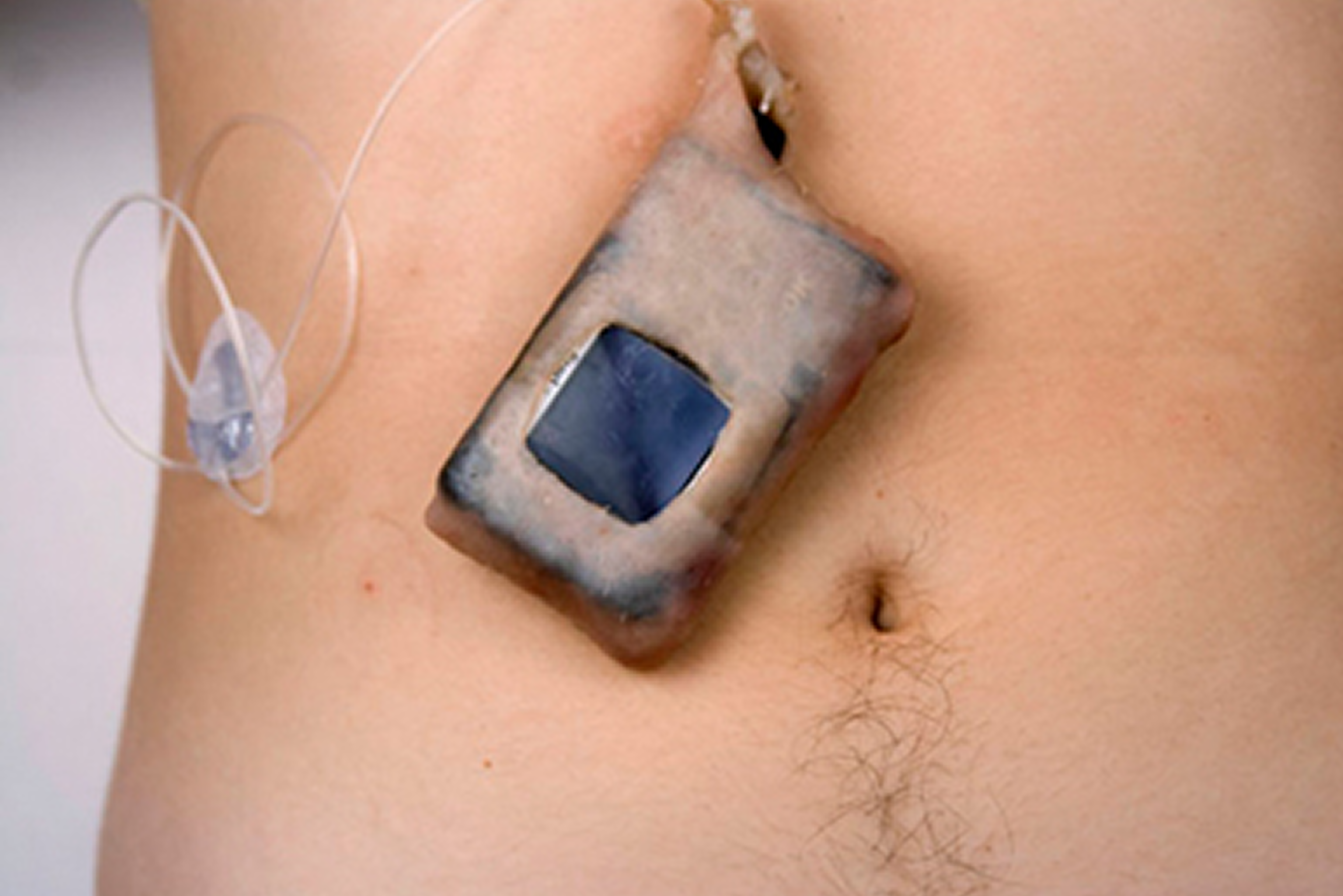 Insulin pump on skin