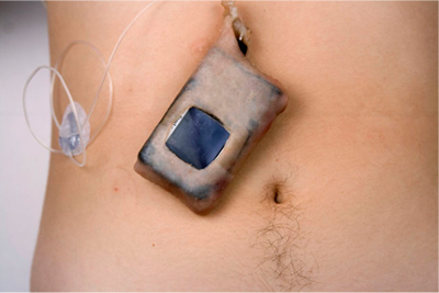 Insulin pump on skin
