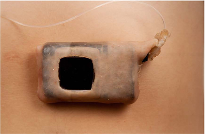 Insulin pump on skin