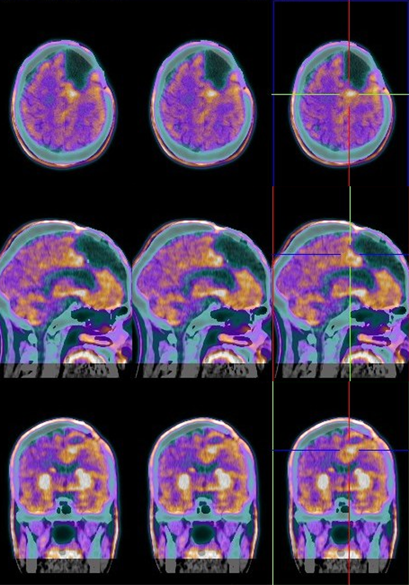 Brain from a PET scan