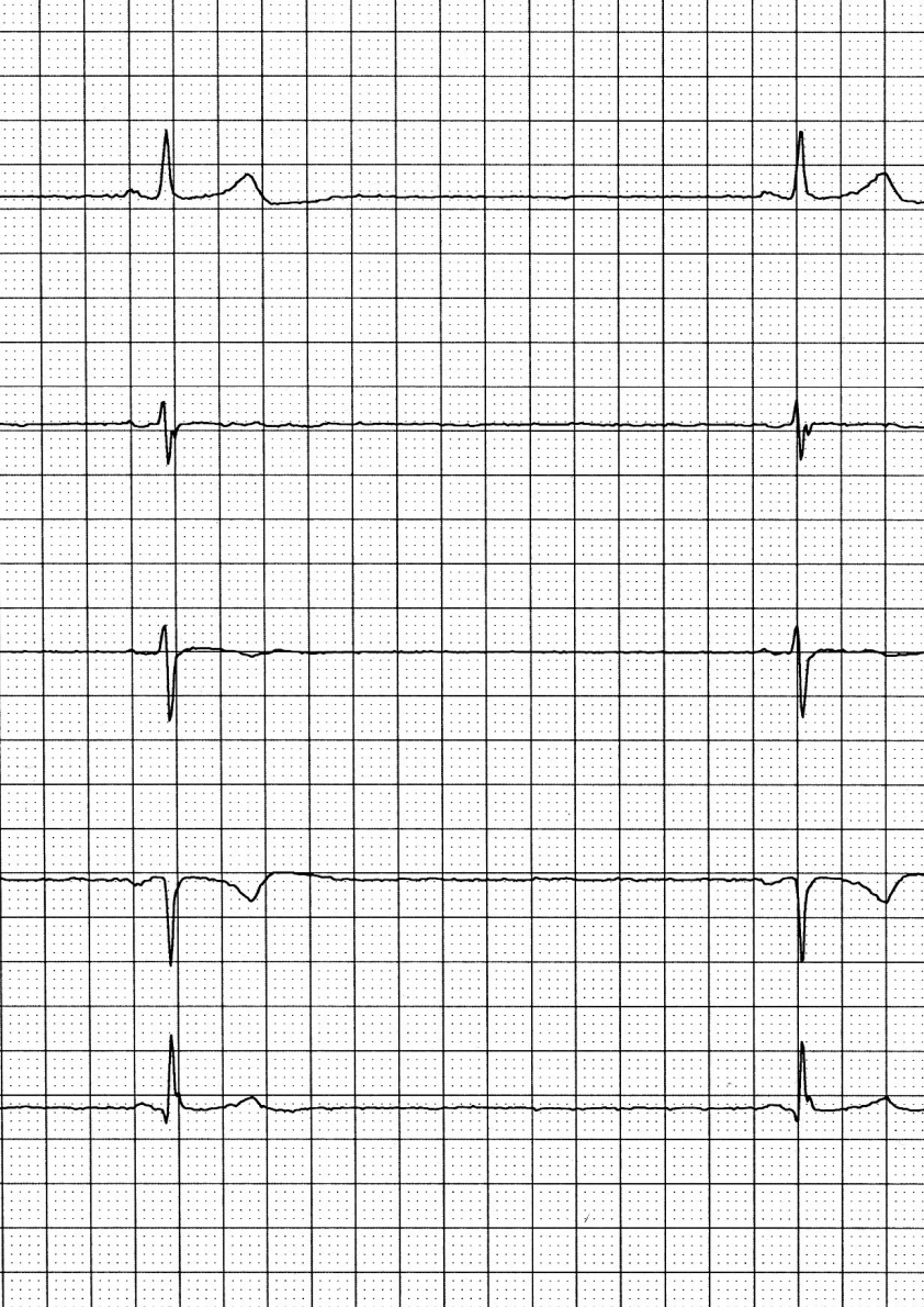 Heart rhythm from an ECG