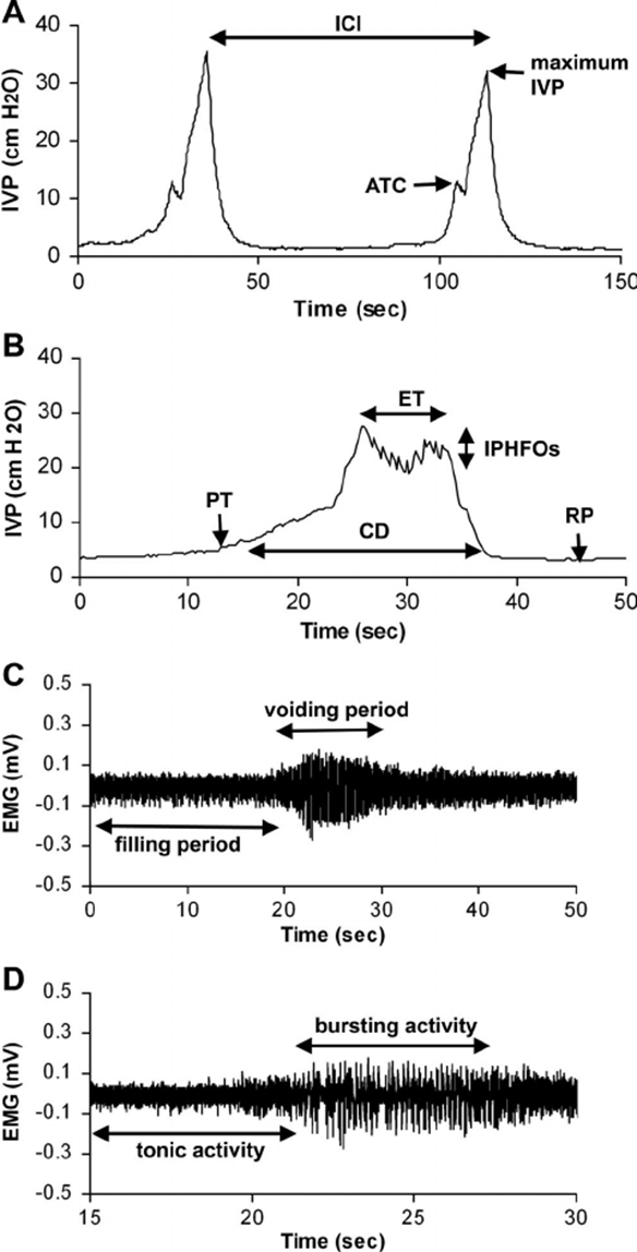 Muscle and nerve interaction from EMG testing